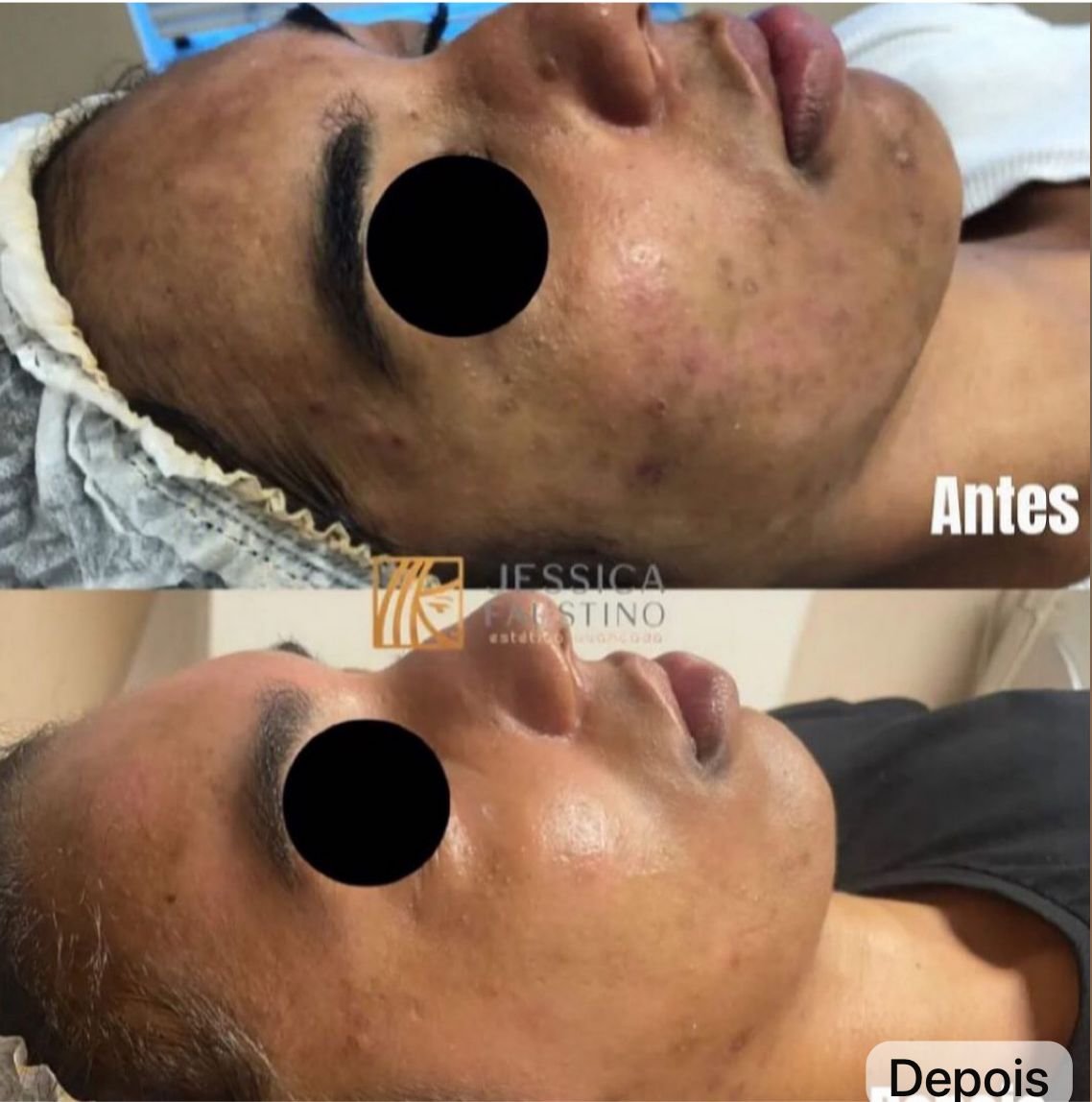 Antes e Depois Laser Lavieen - Caso 2