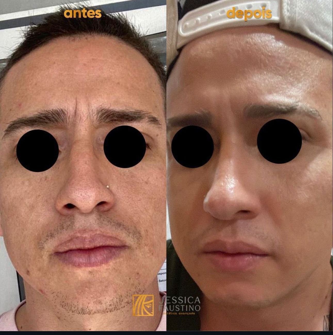 Antes e Depois Laser Lavieen - Caso 3