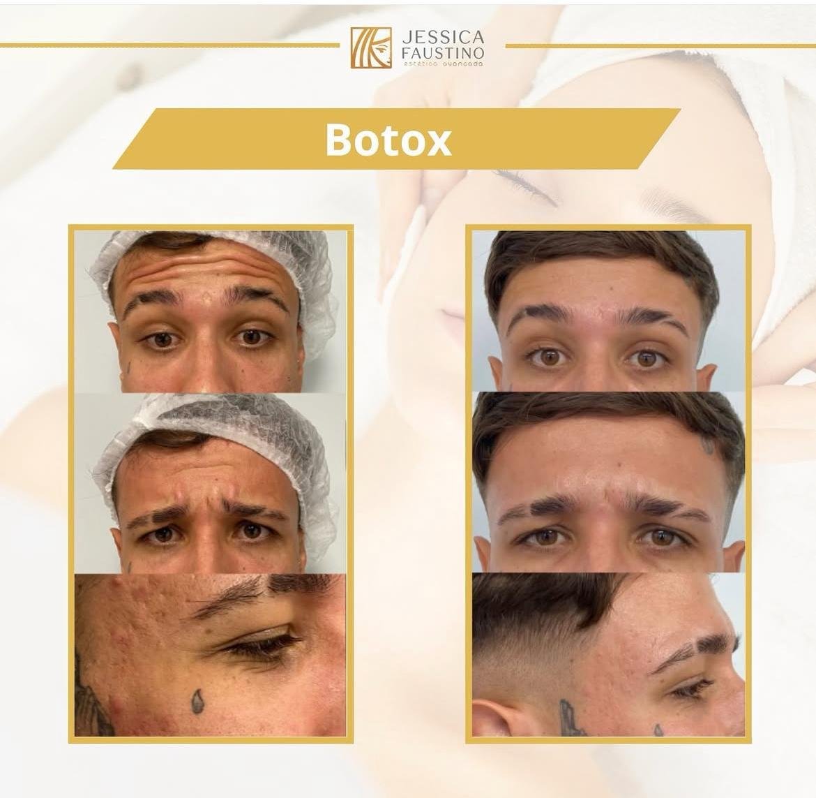 Antes e Depois Botox