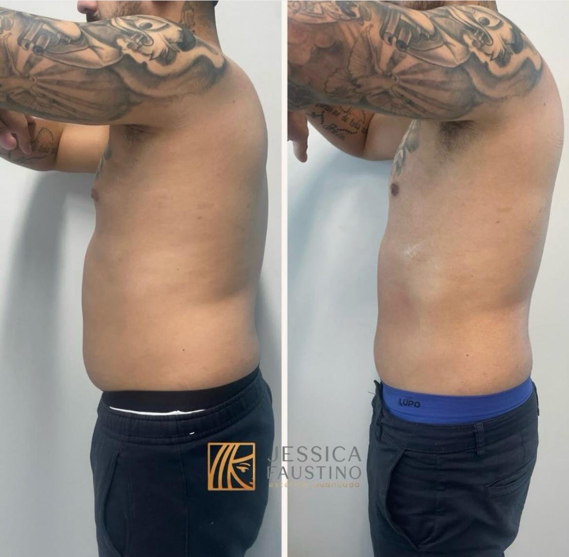 Antes e Depois Criolipólise - Resultados visíveis