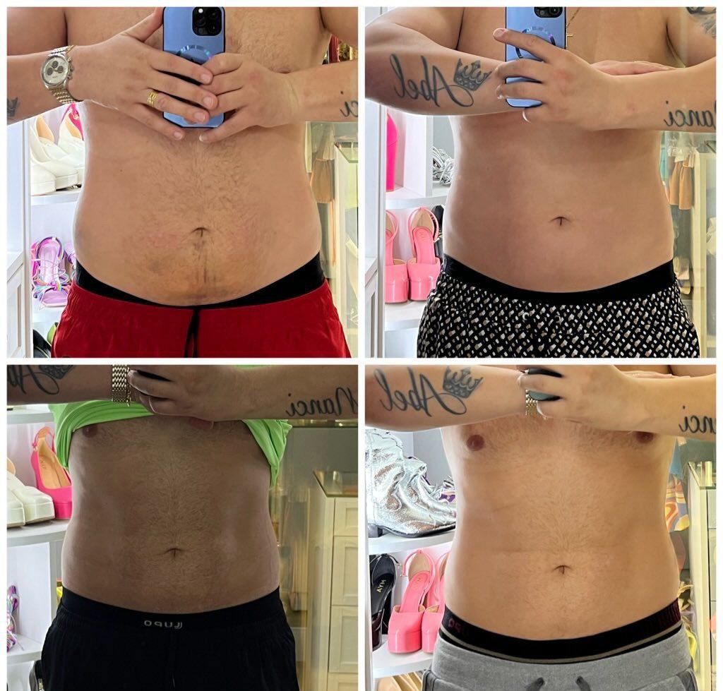 Antes e Depois Criolipólise - Caso 2