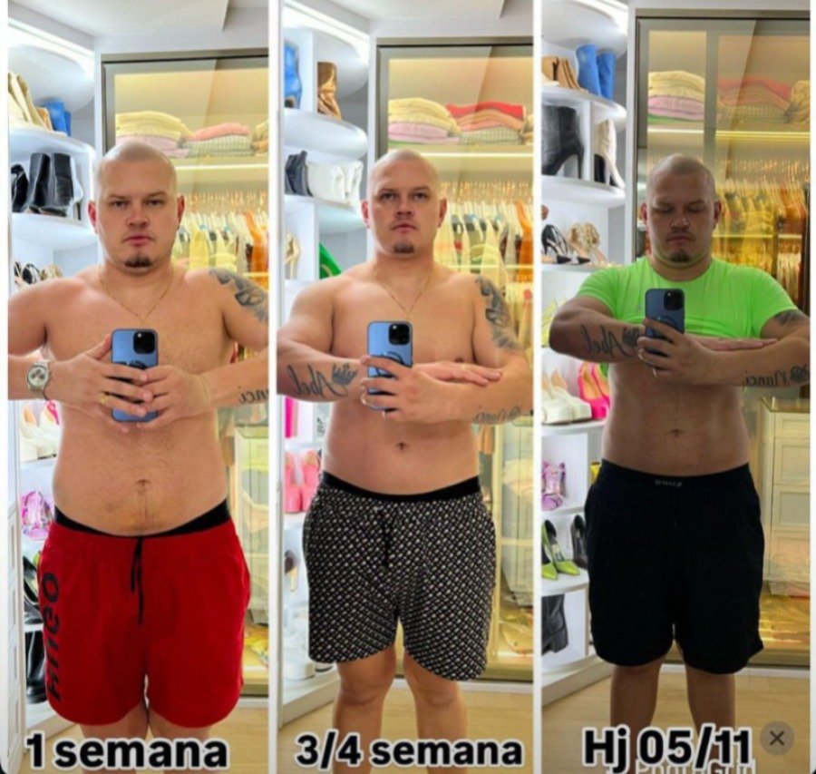 Antes e Depois Endolaser - Resultados visíveis