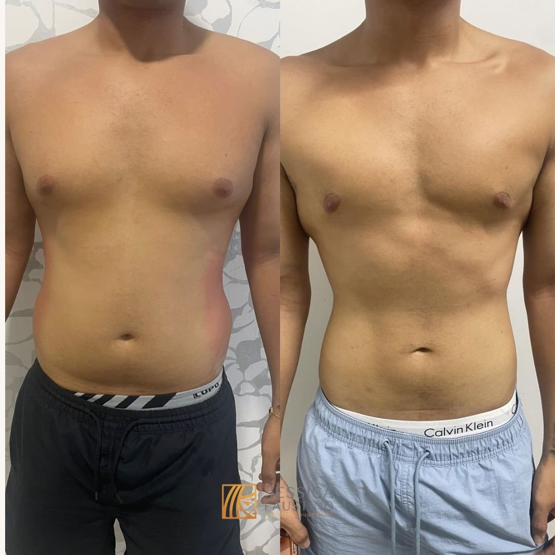 Antes e Depois Enzimas - Caso 2