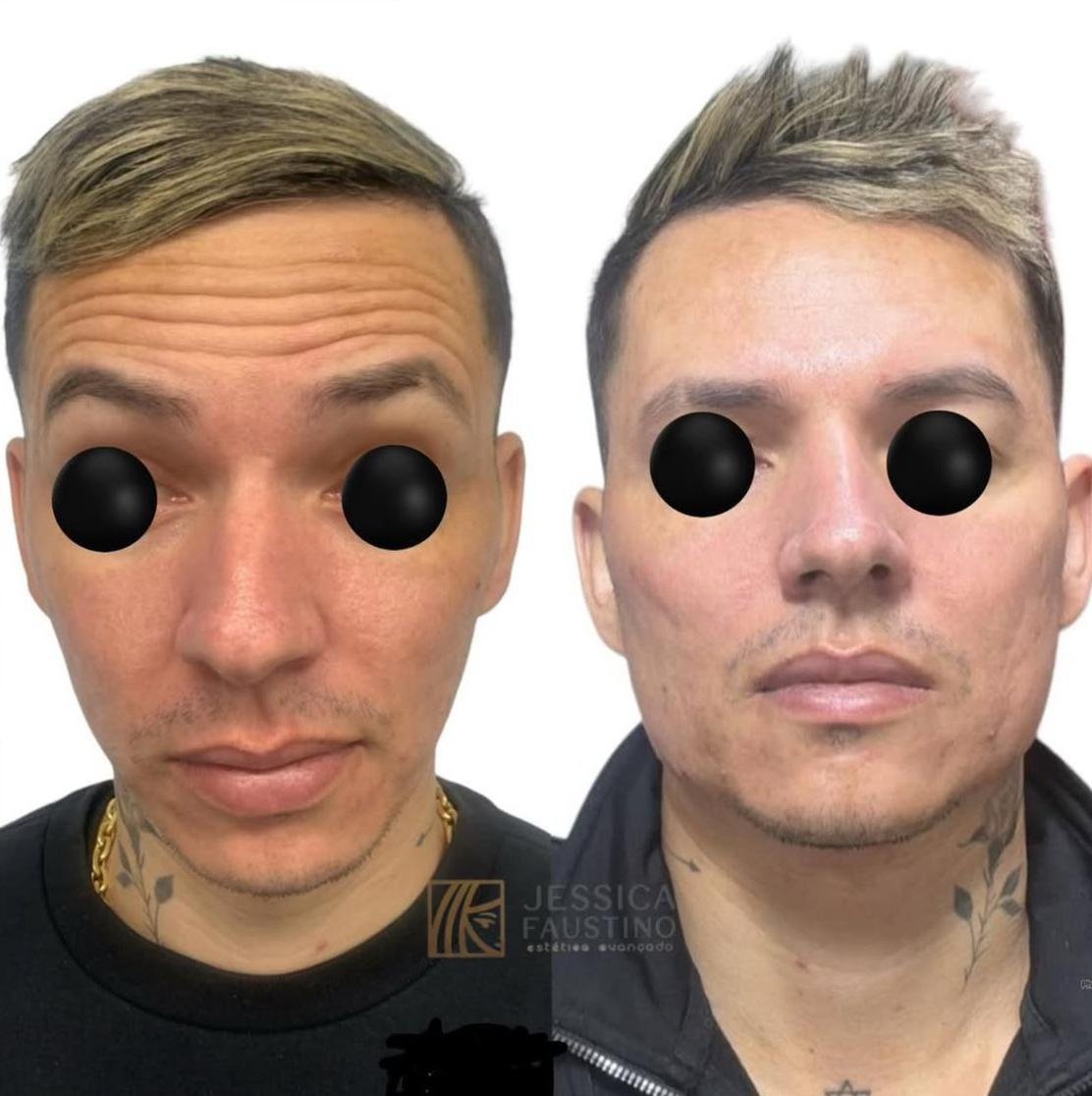 Antes e Depois Harmonização Facial - Caso 1