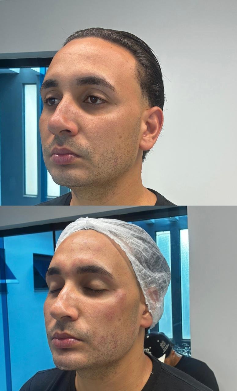 Antes e Depois Harmonização Facial - Caso 2