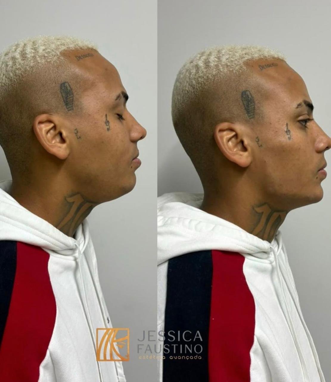 Antes e Depois Harmonização Facial - Caso 3