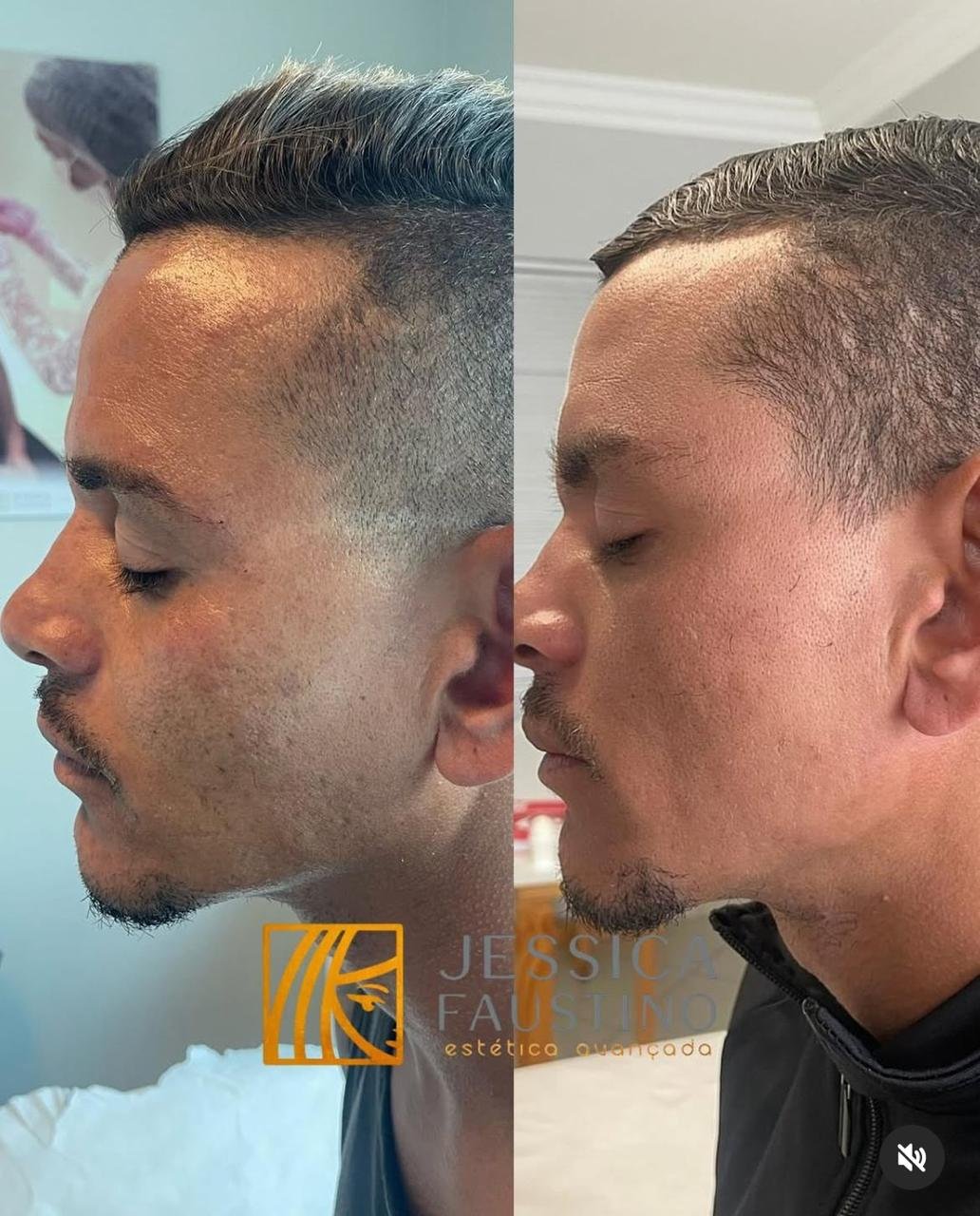 Antes e Depois Laser Harmony - Resultados visíveis