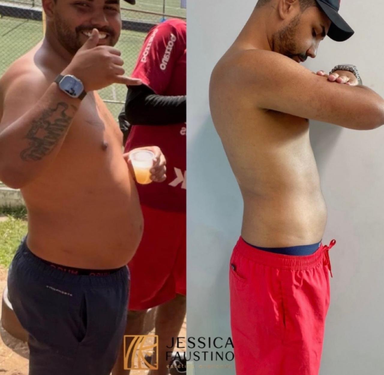 Antes e Depois Tirzepatida - Caso 2