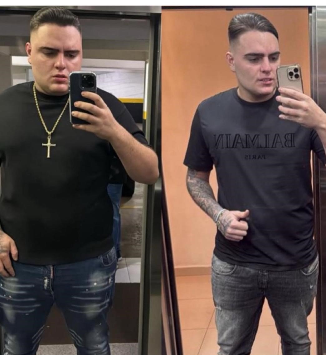 Antes e Depois Tirzepatida - Caso 3