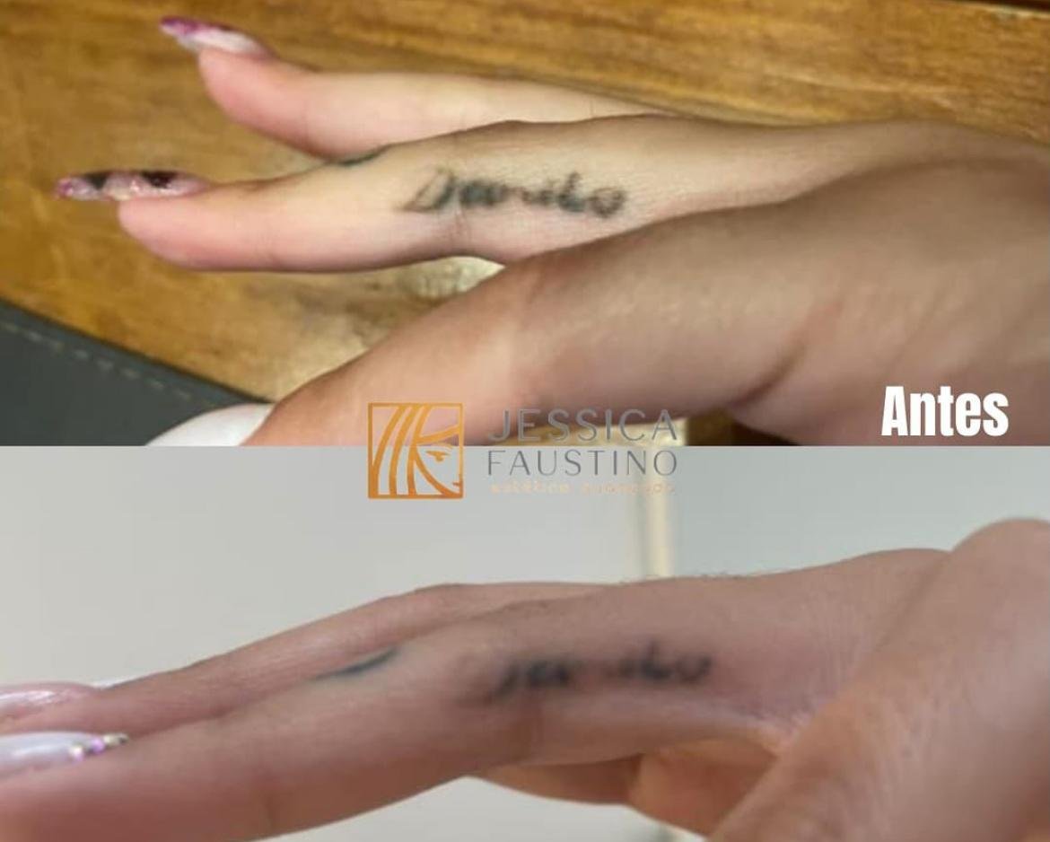 Antes e Depois Remoção de Tatuagem - Caso 1