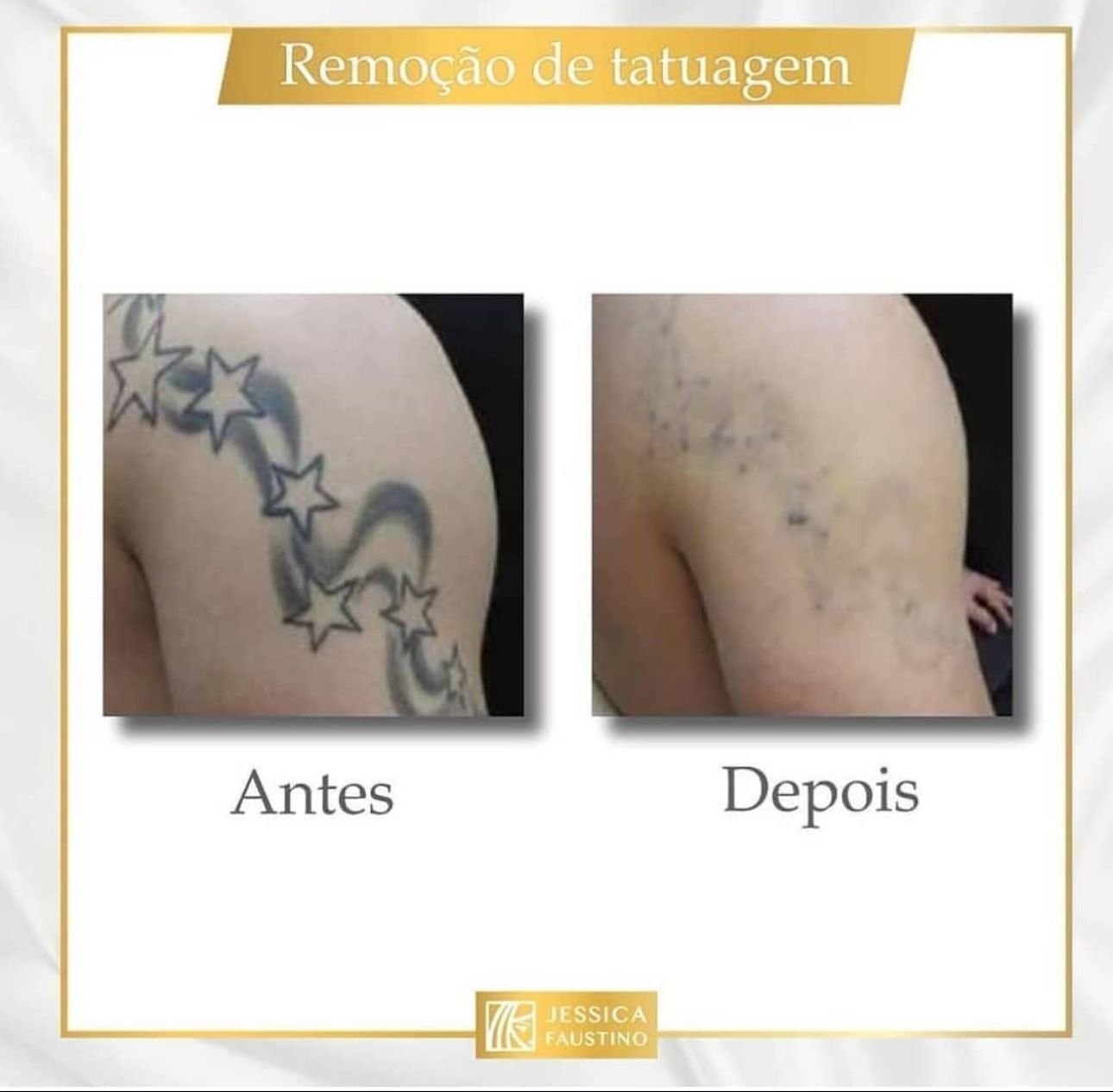 Antes e Depois Remoção de Tatuagem - Caso 3