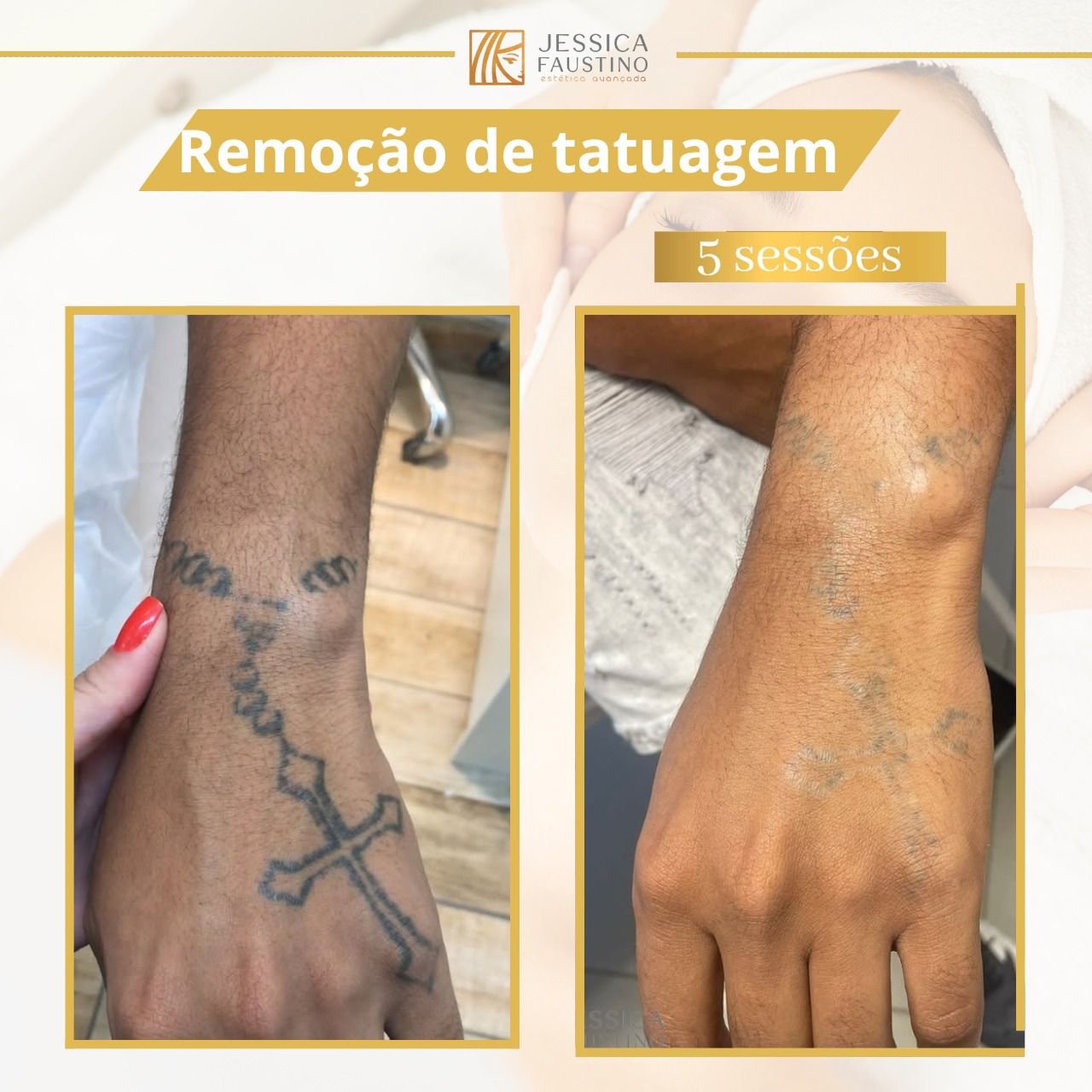 Antes e Depois Remoção de Tatuagem - Caso 4