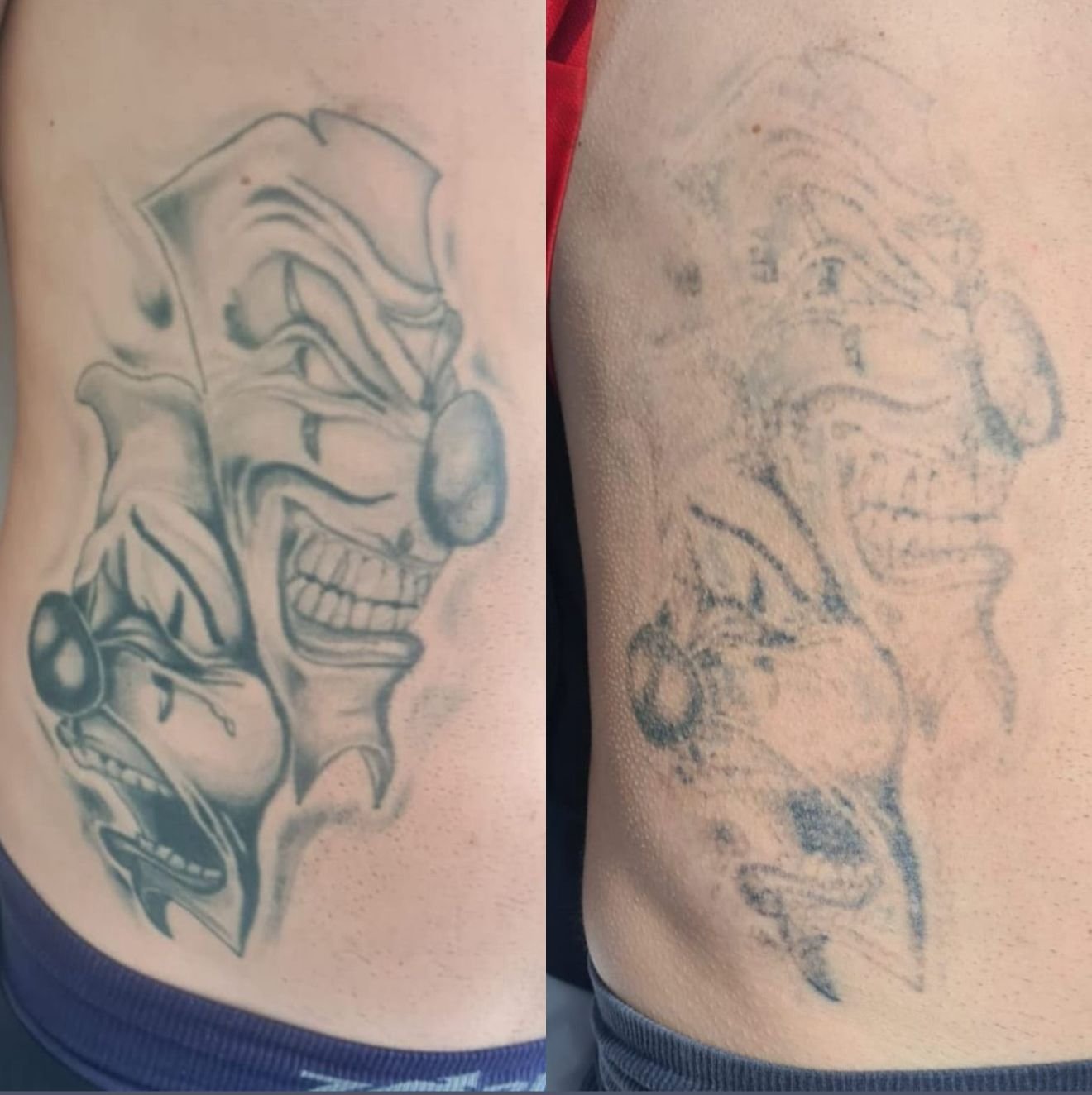 Antes e Depois Remoção de Tatuagem - Caso 5