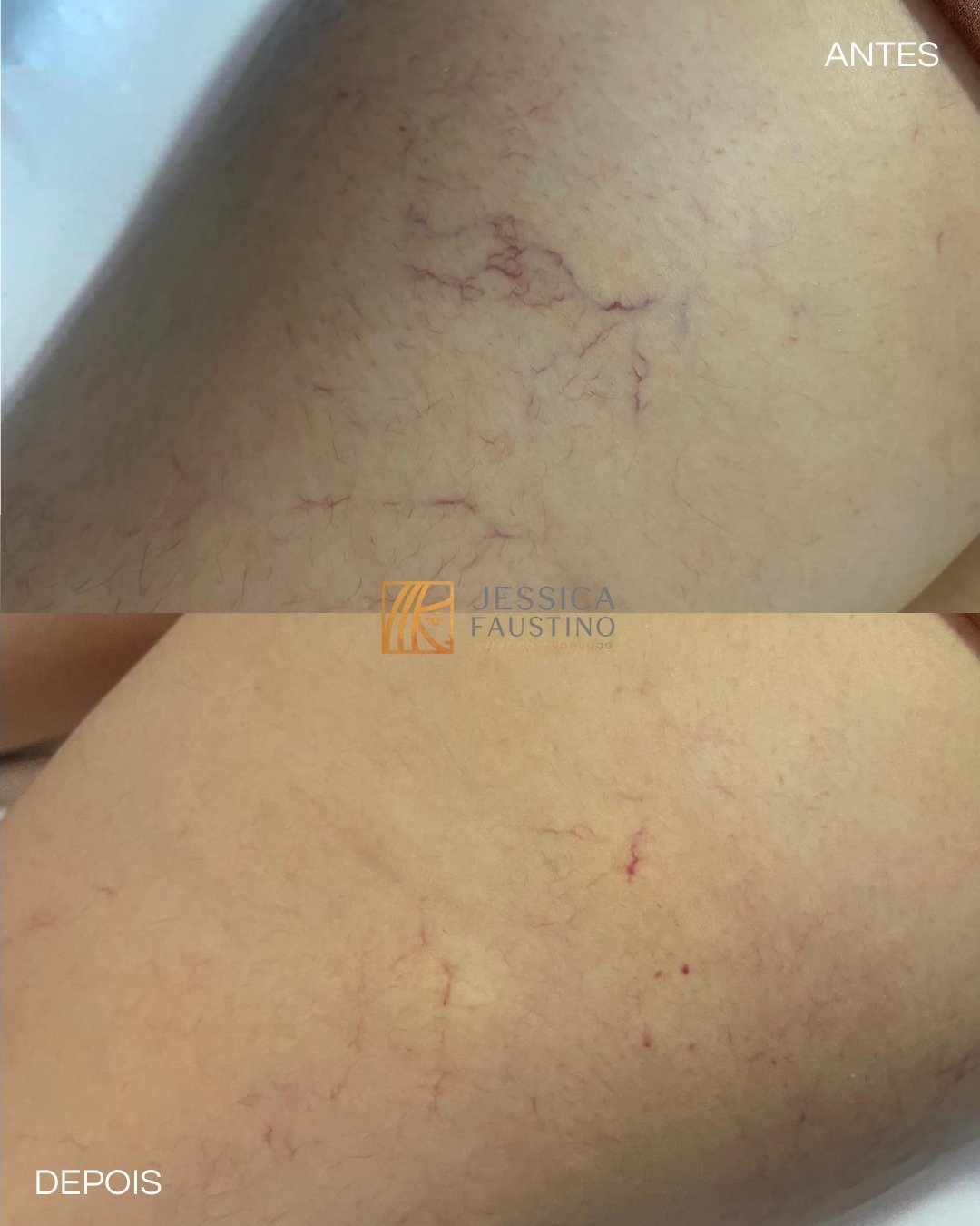 Antes e Depois Secagem de Vasinhos