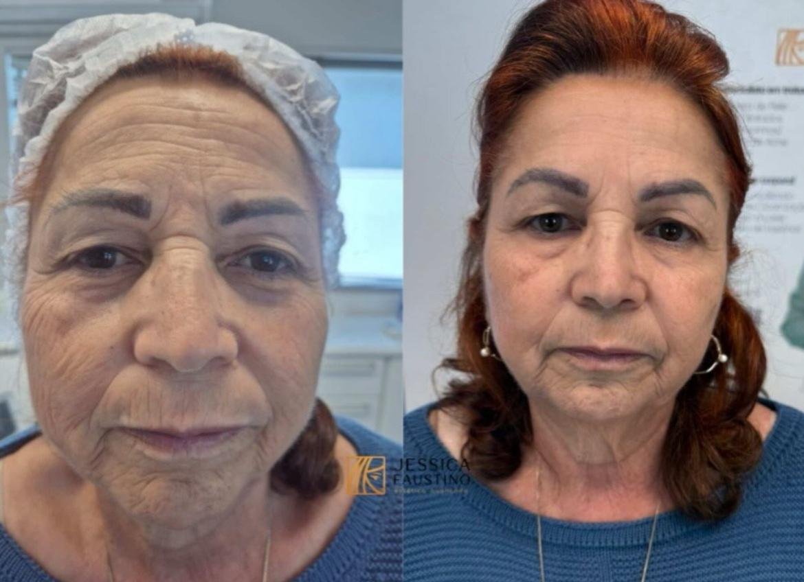 Antes e Depois Ultraformer - Resultados visíveis