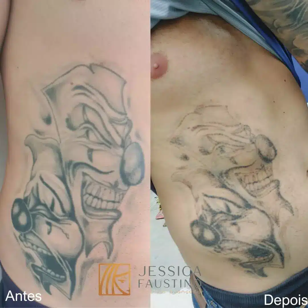 jessica-faustino-remocao-de-tatuagem.webp