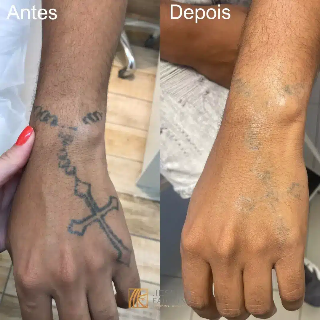 remover-tatuagem.webp